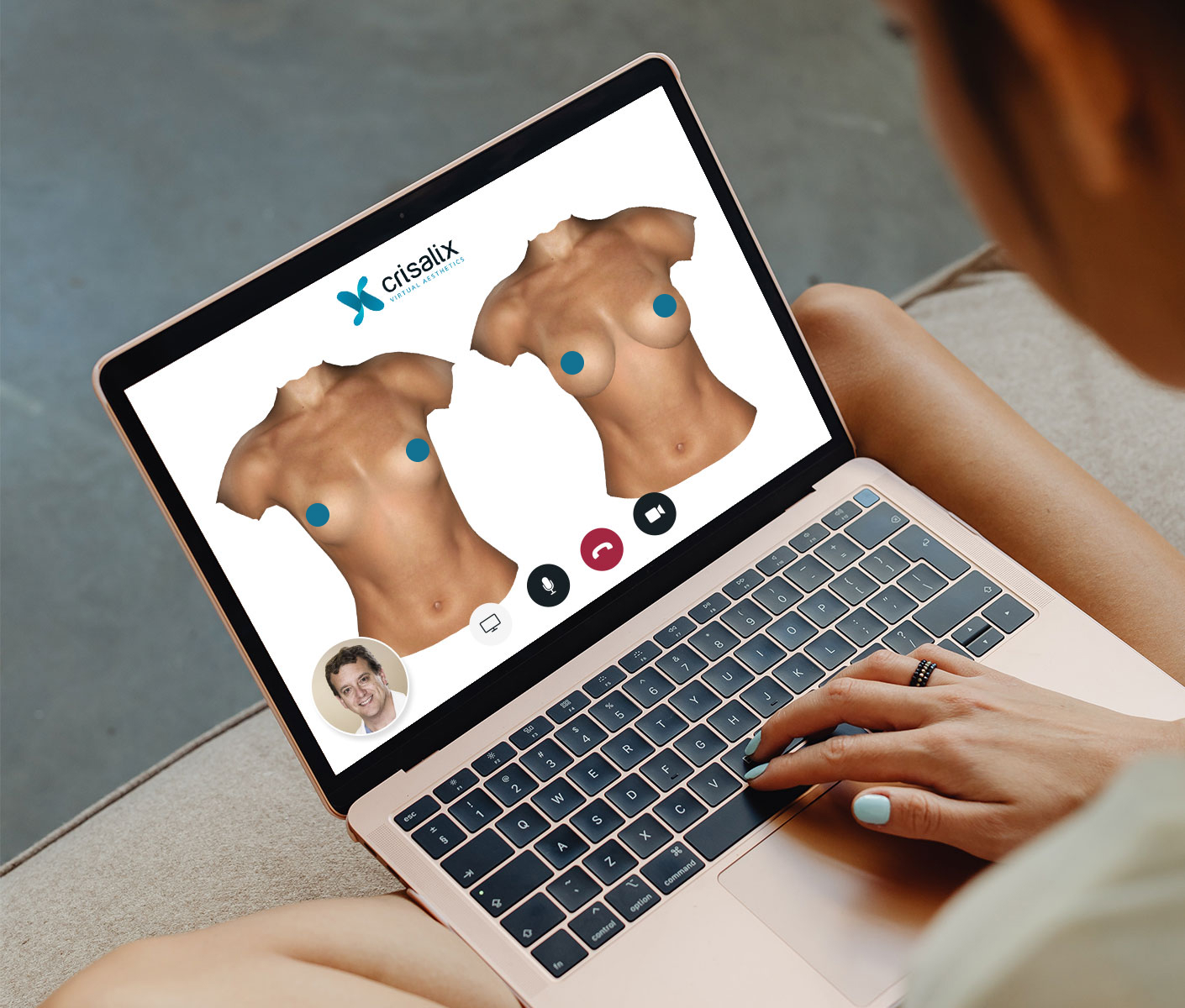 환자가 노트북에서 Crisalix 앱으로 3D 유방 시뮬레이션을 보면서 의사와 화상 상담을 받고 있습니다.